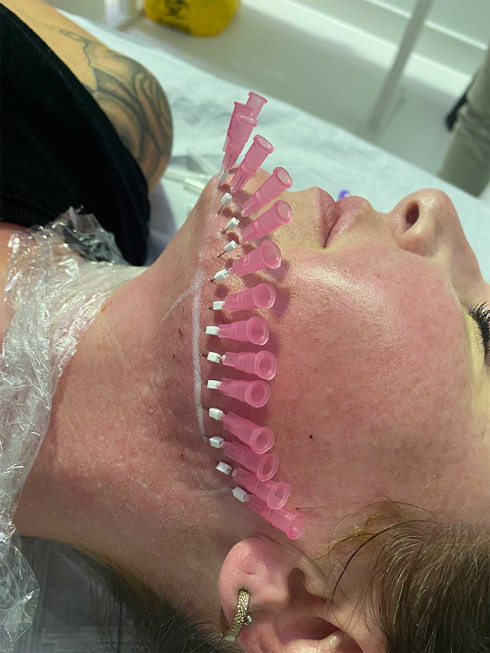 Woman receiving PDO Mono Threads treatment for facial rejuvenation at sydney skin clinic paddington