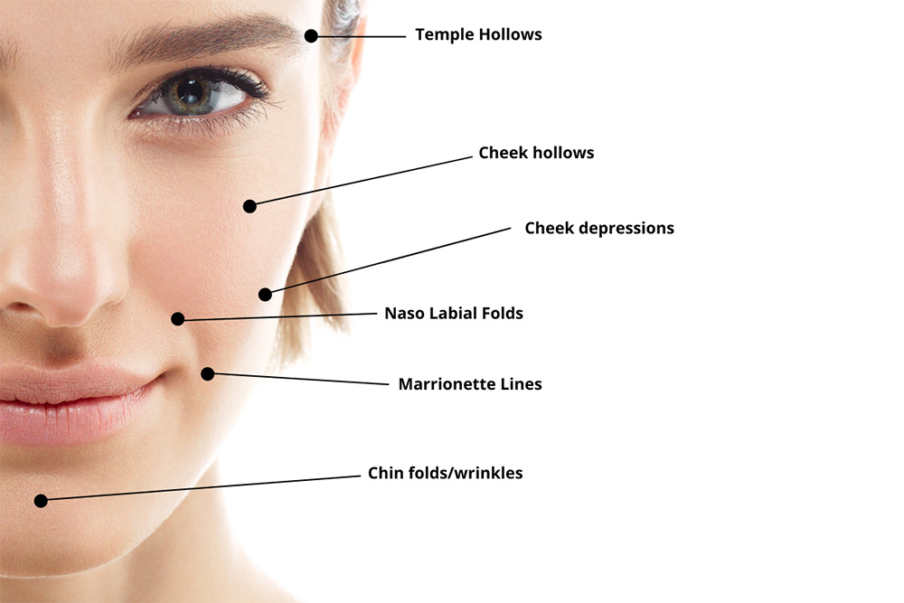 collagen stimulating filler areas of use and purposes diagram