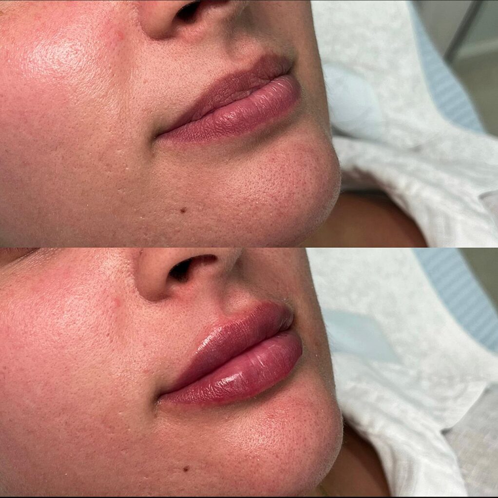 Myth Busted Does Lip Filler Hurt? Restoration Medicine