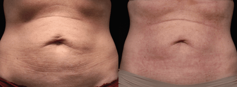 Morpheus8 stomach fat reduction and skin tightening