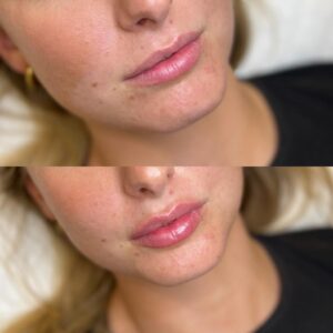 profhilo dermal lip injection with botox lip flip aesthetic clinic sydney